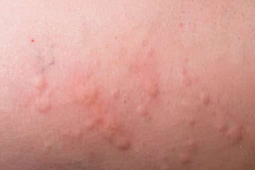 A mí vich con la psoriasis