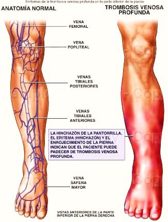 Que ejercicio hacer del dolor en los riñones
