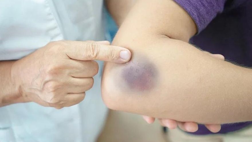 Moretones, ¿por qué me salen sin que me dé golpes?